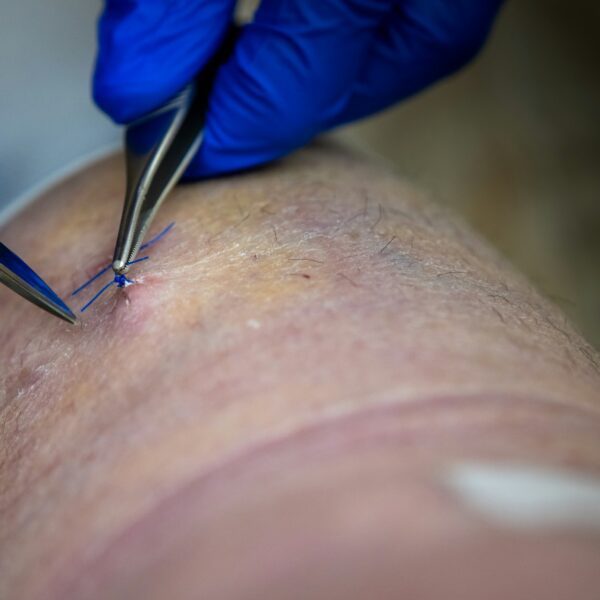 Why Spider Veins Are More Than a Cosmetic Concern for Many People