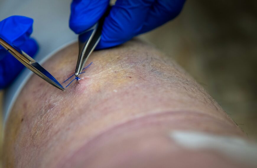Why Spider Veins Are More Than a Cosmetic Concern for Many People